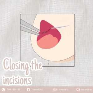 Minimally Invasive Technique : Close the incision with absorbable stitch